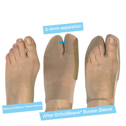 OS1st Bunion Brace HV3